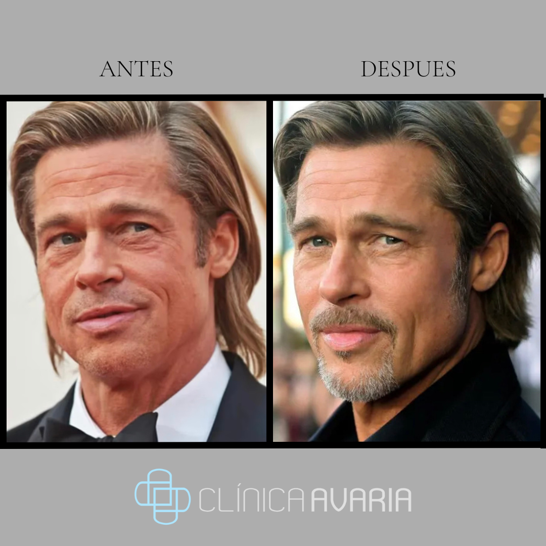 Antes y después de Brad Pitt botox, toxina botulínica, acido hialurónico, fillers, rellenos