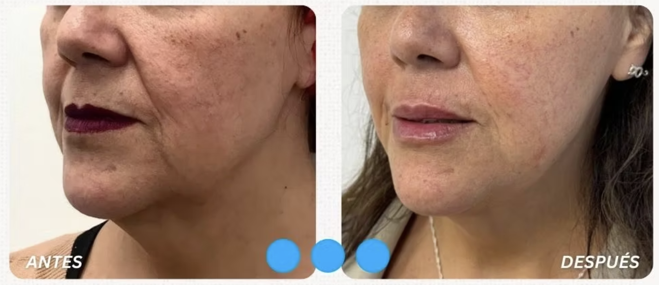 Antes y Despues HIFU Liftera Caso 3